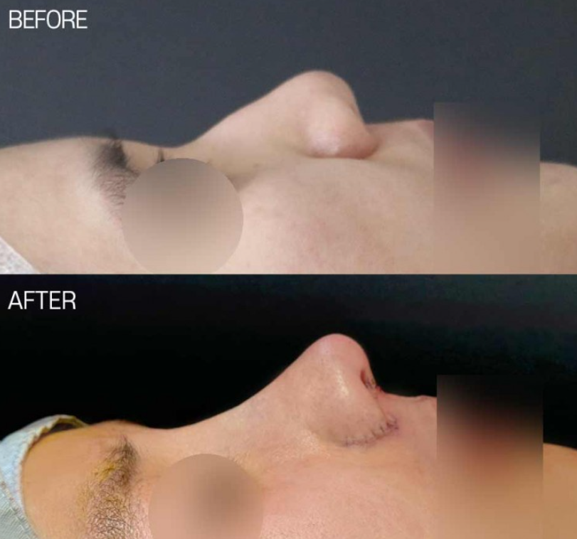 매부리코성형 전후 얼마나 차이날까? 복코와 넓은 콧볼까지 함께 고려한 변화 관련 이미지 2