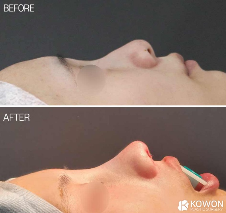 [Hump Nose Correction] Cowon Plastic Surgery Clinic: An Actual Case Showing Changes to the Drooping Tip Immediately After Implant-Free Rhinoplasty image 2