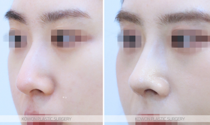 Q. Worried About Crooked Nose Surgery, What Nose Surgery Direction Should Be Considered Before Double Jaw Surgery image 5