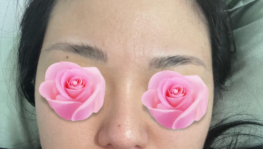 This is a review of nose surgery for a bulbous nose using donated rib cartilage at Kowon Plastic Surgery! image 4