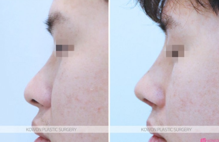 Q. I’m interested in male rhinoplasty and eye surgery—where is a good clinic for male nose surgery? image 10