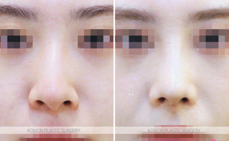 Q. I’m asking because I’m worried about complications after tip surgery and the duration of non-incisional alar reduction. image 9