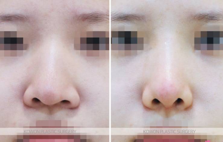 Q. I’m worried about side effects from nose surgery. Please tell me how to reduce swelling after nose surgery. image 6