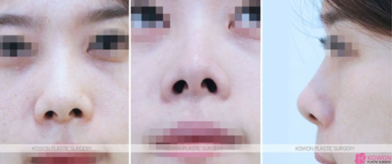 낮은코성형 코끝부터 비순각까지 함께 봐야 하는 3가지 이유 관련 이미지 5