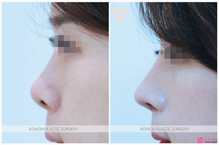 자연스러운 입체감을 완성하는 들창코 수술, 만족도를 높이는 코원성형외과의 노하우 관련 이미지 4