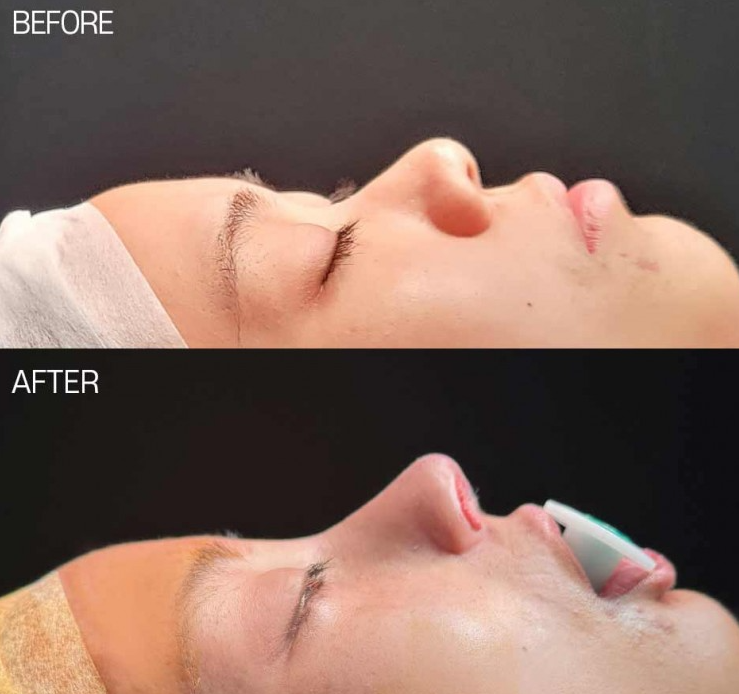 Low Nose Rhinoplasty: A Change to a More Three-Dimensional Impression, 3 Questions About Tip Cartilage Repositioning image 2