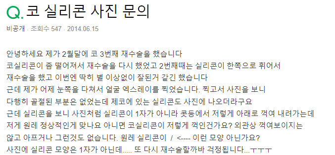 Q. 코재수술 2번, 코실리콘 모양이 이상해요. 관련 이미지 2