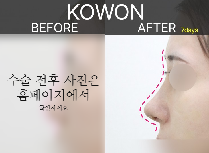 여자매부리코, 복코까지 함께 고려해야 하는 3가지 이유 관련 이미지 6