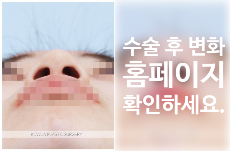 낮은코 성형 과하지 않은 높이와 부드러운 라인을 고려한 코원성형외과 사례 관련 이미지 3