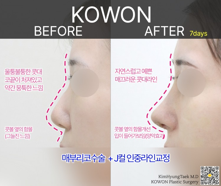 Q. Nostril Reduction Surgery? Reducing Nose Width? I Want to Improve My Broad, Bulbous Nose! image 6
