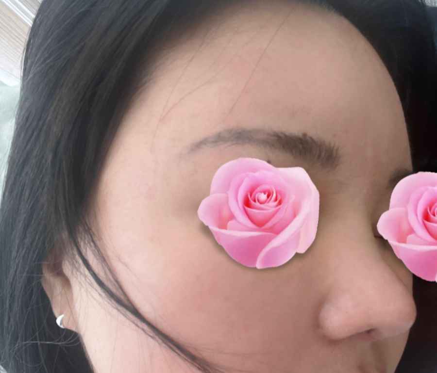 This is a review of nose surgery for a bulbous nose using donated rib cartilage at Kowon Plastic Surgery! image 8