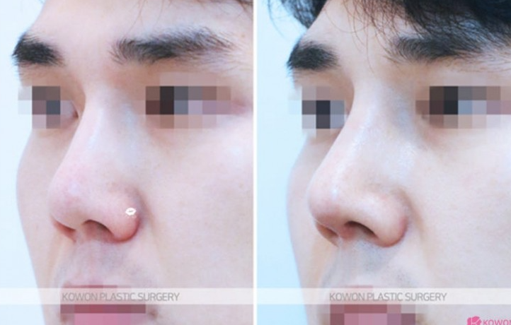 Q. When Is Revision Nose Surgery or Nose Reconstruction Surgery Needed, and Tips for Choosing a Well-Known Revision Nose Surgery Clinic image 8