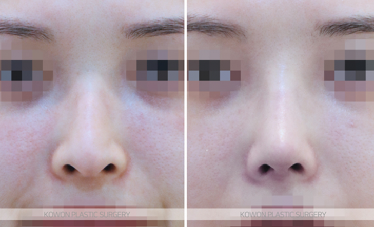 Q. I’m worried that a 4 mm silicone implant for a nose bridge augmentation will look obvious image 8