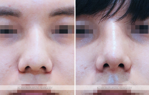 How Long Does Nose Surgery Swelling Last? A Summary of Immediate Changes and the Recovery Process image 5