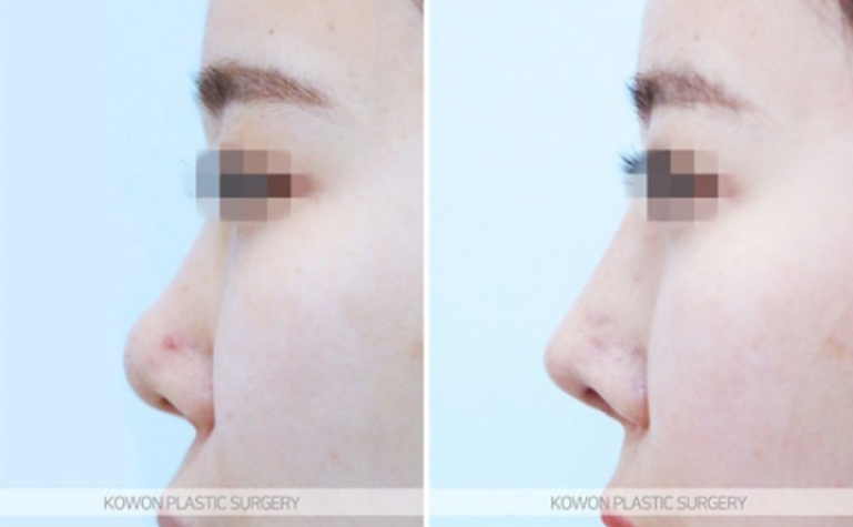 Will Autologous Rib Cartilage Nose Surgery Look Natural? A Process That Refined the Drooping Tip and Glabella Line image 8