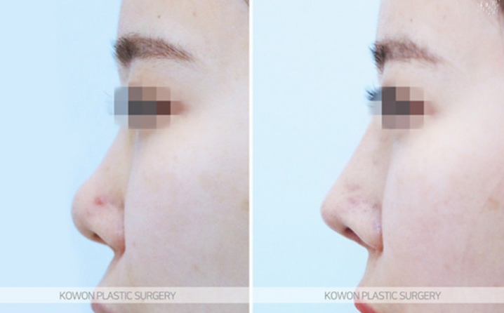 Q. If You’re Considering Revision Rhinoplasty image 10