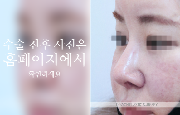 자가늑 코성형으로 코끝 처짐과 구조를 함께 고려해야 하는 이유 관련 이미지 7