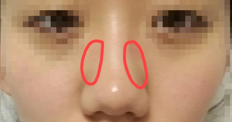 Q. I’m planning to get a nose job—please tell me the types of rhinoplasty (bulbous nose surgery) image 3