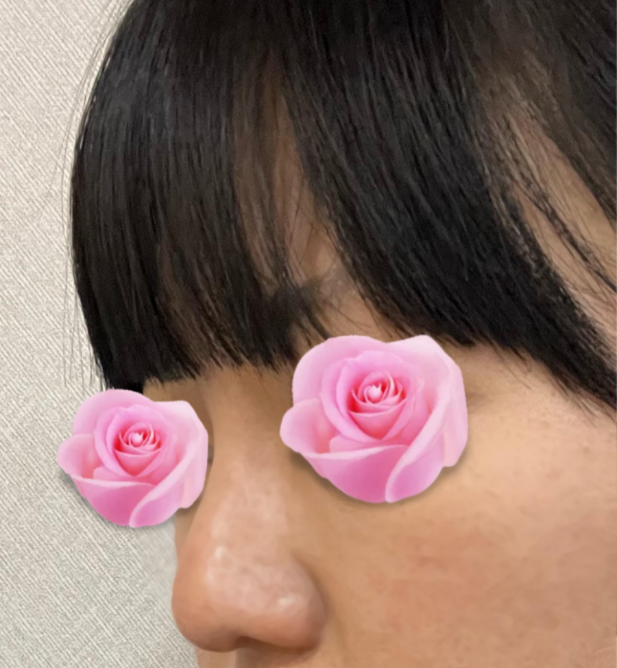 This is a review of nose surgery for a bulbous nose using donated rib cartilage at Kowon Plastic Surgery! image 1