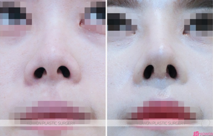 Q. After nose surgery, I can’t make a pig nose. Will removing the silicone fix it? image 7