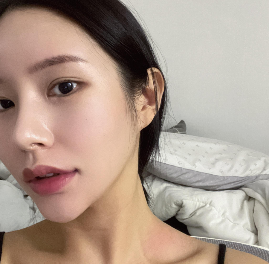 과도하게 화려한코, 귀연골에 비중격코수술로 자연스럽게 개선 됐어요! 관련 이미지 4