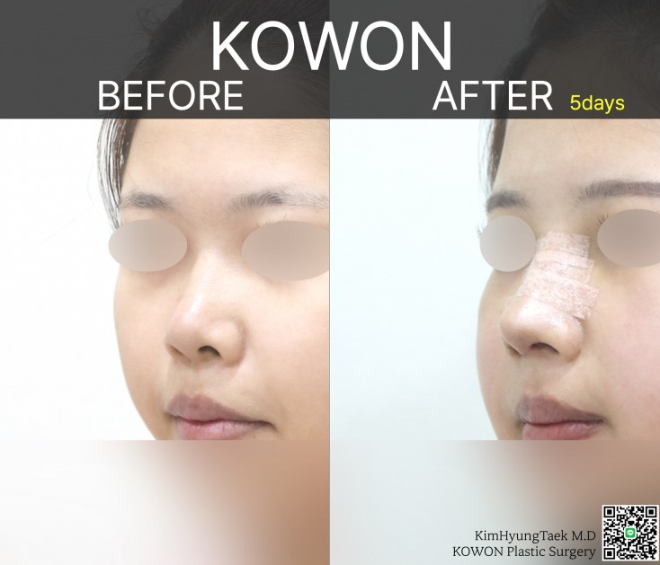 Q. My nose became a hooked nose after nose surgery.. What kind of revision surgery would be needed? image 4