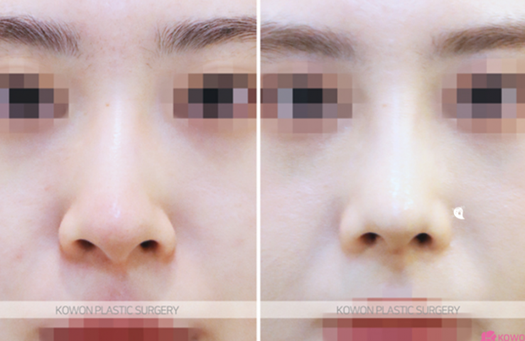 Low Nose Rhinoplasty: A Change to a More Three-Dimensional Impression, 3 Questions About Tip Cartilage Repositioning image 4
