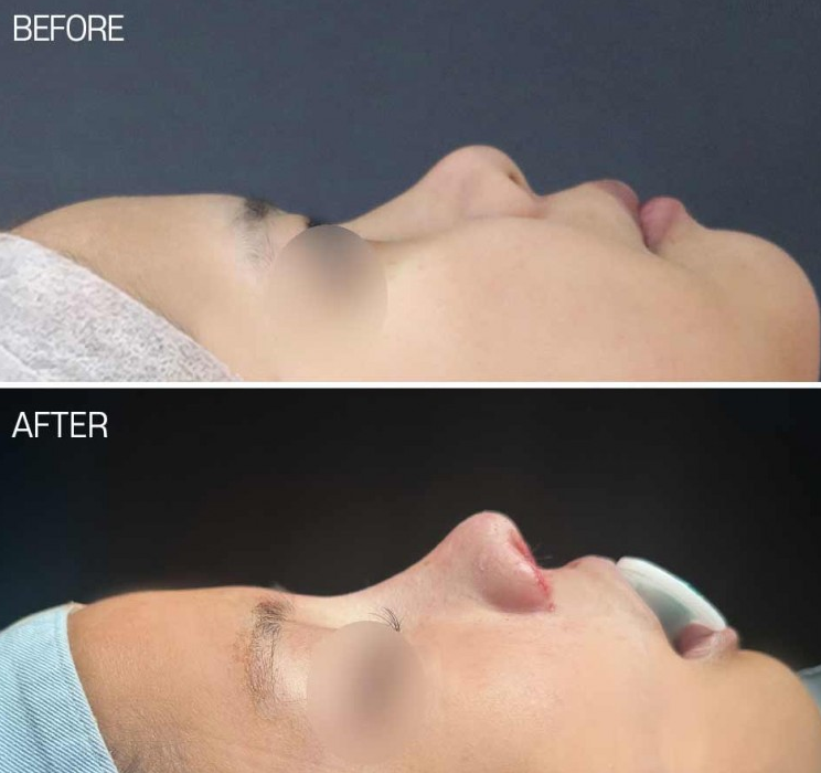 Q. Nostril Reduction Surgery? Reducing Nose Width? I Want to Improve My Broad, Bulbous Nose! image 7