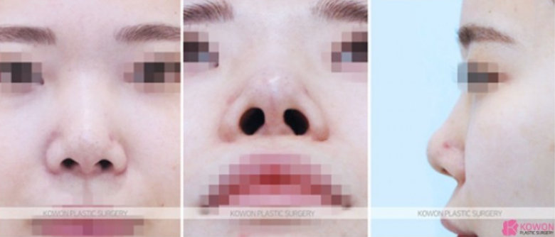 Will Autologous Rib Cartilage Nose Surgery Look Natural? A Process That Refined the Drooping Tip and Glabella Line image 5