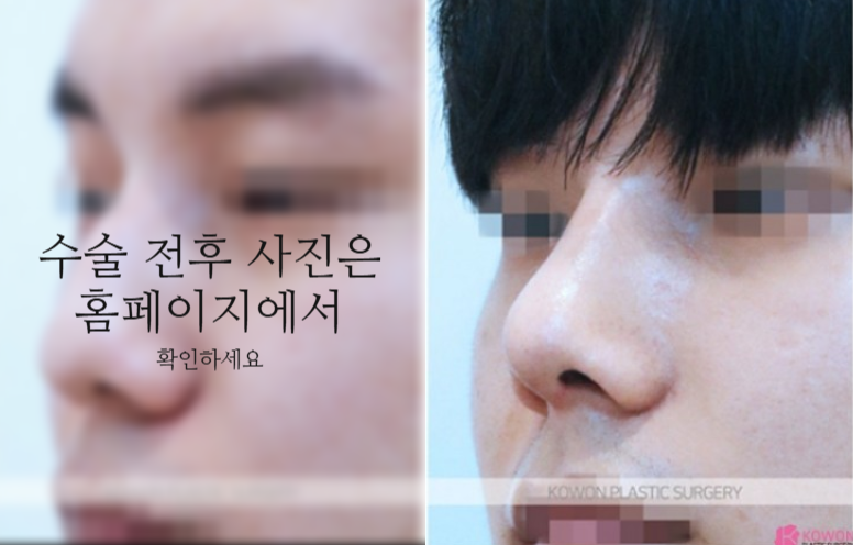 The Recovery Period After Deviated Septum Surgery and 3 Key Factors Determining Male Nose Balance image 7