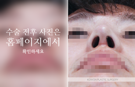 남자복코수술 매부리코와 콧볼을 함께 교정해야 자연스러운 이유 관련 이미지 4