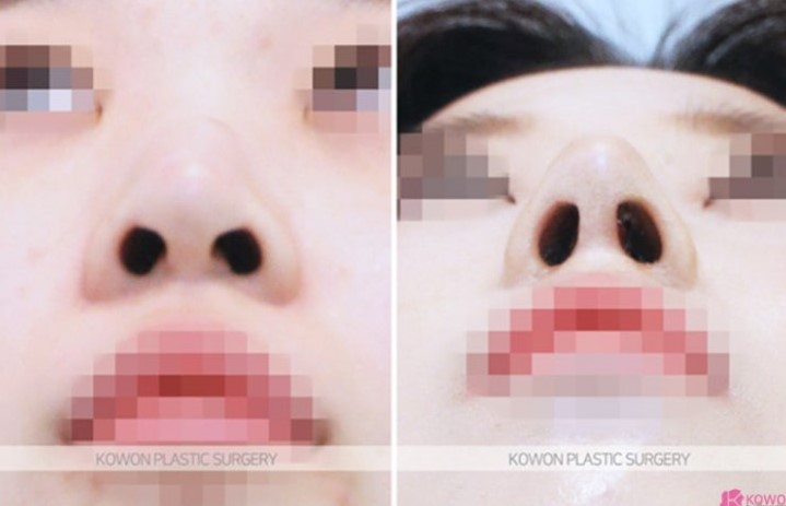 Q. In a deviated nose surgery, will failing to correct the crooked nasal bone cause problems with nose growth? image 5