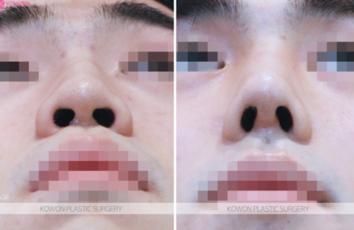 Q. Concerns After Hump Nose Rhinoplasty and Nasal Fracture Surgery: Possibility of Revision Surgery for Men image 8