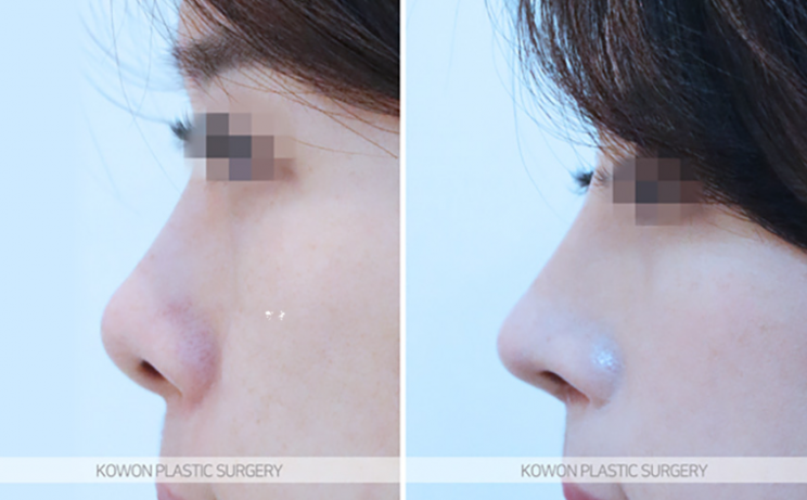 Q. Questions About Bulbous Nose Surgery and Post-Jaw Surgery Nose Surgery Answered image 9