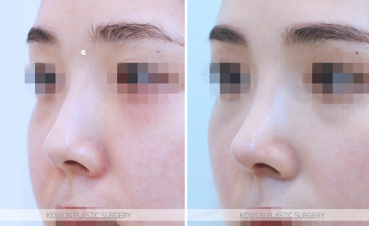 Q. I want to improve my nostrils without artificial implants in upturned nose surgery image 8