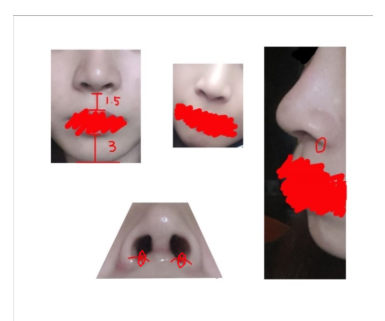 Q. Nostril Reduction Surgery? Reducing Nose Width? I Want to Improve My Broad, Bulbous Nose! image 3