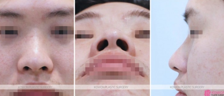 Q. I’m interested in male rhinoplasty and eye surgery—where is a good clinic for male nose surgery? image 4
