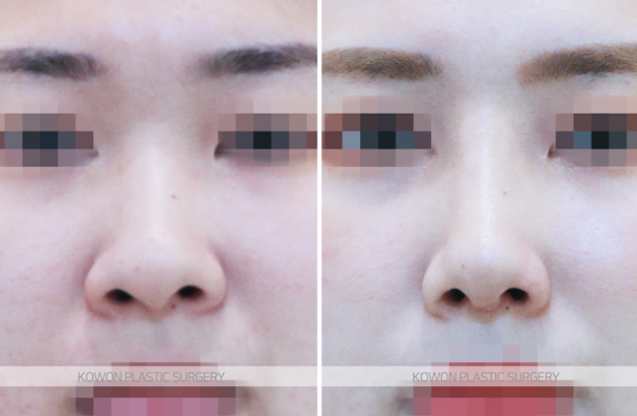 Q. Nostril Reduction Surgery? Reducing Nose Width? I Want to Improve My Broad, Bulbous Nose! image 8