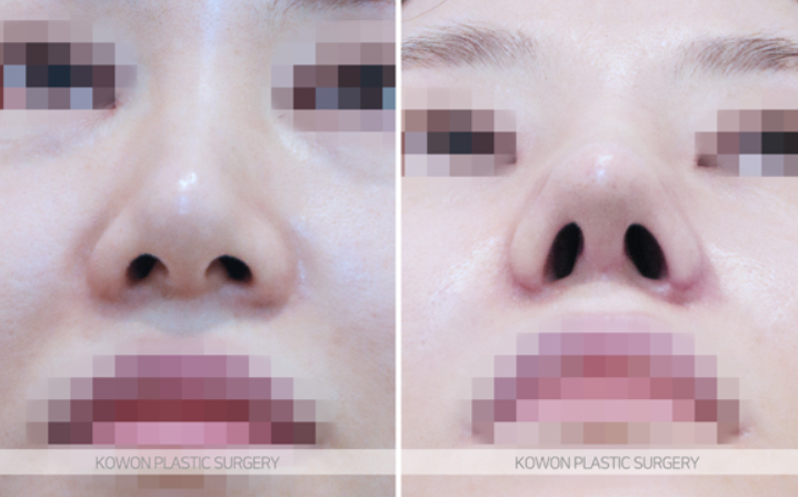 Q. 고민 about alar base surgery: do the nostrils need shape correction? image 6