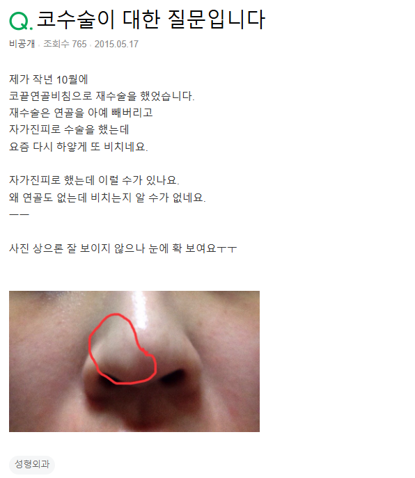 Q. Revision surgery for cartilage visibility — I had dermis-fat grafting, but it’s visible again. image 2