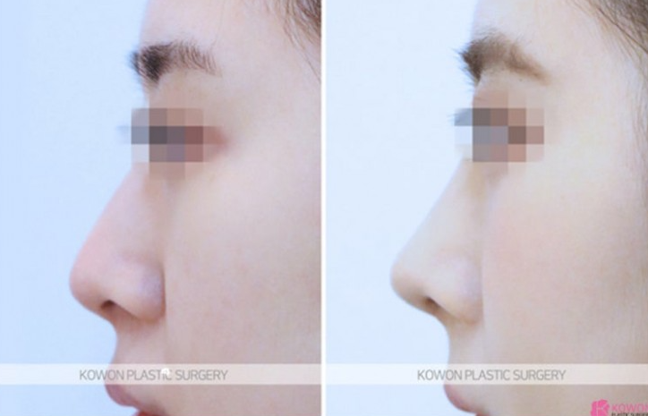 Q. Is non-open nose surgery possible? A complete guide to concerns about general anesthesia image 7