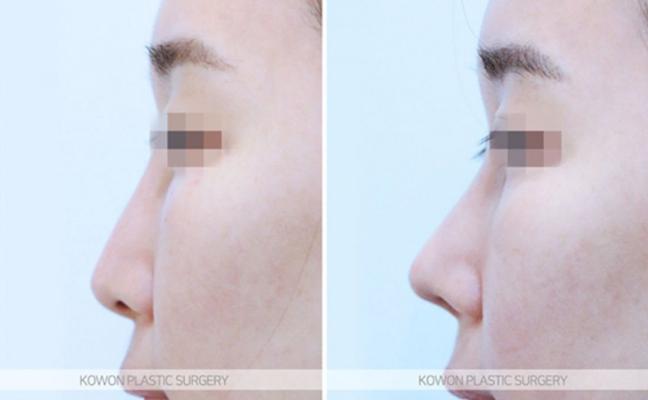 What Is Refined Natural Nose Surgery? Check This If You’re Considering Small Nose Surgery image 6