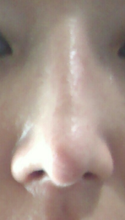 Q. After silicone nose surgery, do I need a revision if the bridge has collapsed? image 4