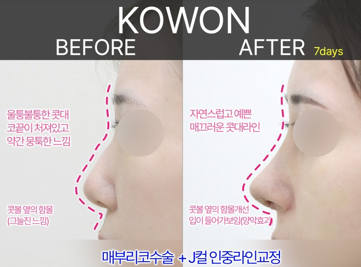 여자매부리코, 복코까지 함께 고려해야 하는 3가지 이유 관련 이미지 4