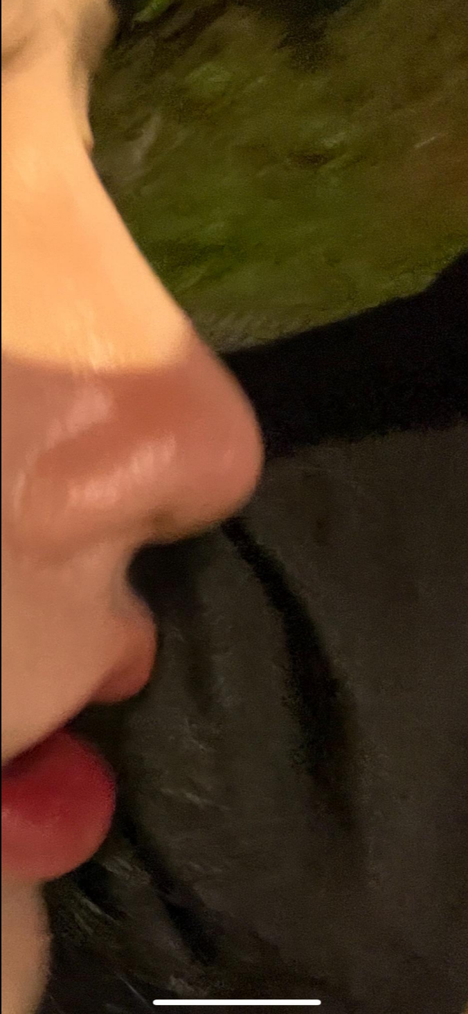 울퉁불퉁해 신경 쓰이던 코를 코원성형외과에서 낮은코와 매부리코교정으로 매끄럽게 만들었어요! 관련 이미지 9