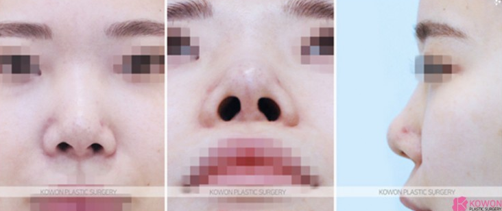 Q. If You’re Considering Revision Rhinoplasty image 5