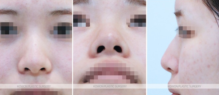Q. 코끝수술 코 실리콘 제거 후 돼지코 안 되나요? 관련 이미지 5