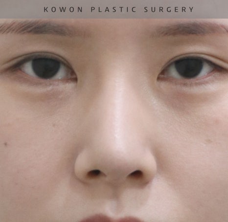 과도하게 화려한코, 귀연골에 비중격코수술로 자연스럽게 개선 됐어요! 관련 이미지 18
