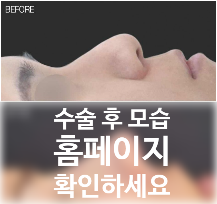 코원성형외과 리브핏으로 완성하는 남자 코끝 성형 및 콧대 라인 교정 관련 이미지 2