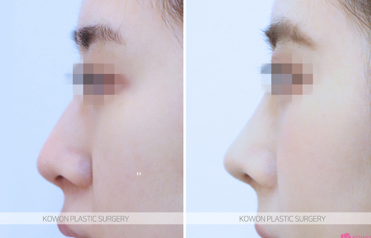 Q. Which is the right choice: nasal osteotomy or tip elevation in nose surgery? image 7